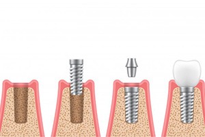 Illustration of placing abutment and crown on implant