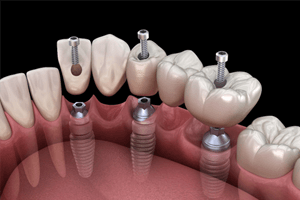 a computer illustration of an implant denture